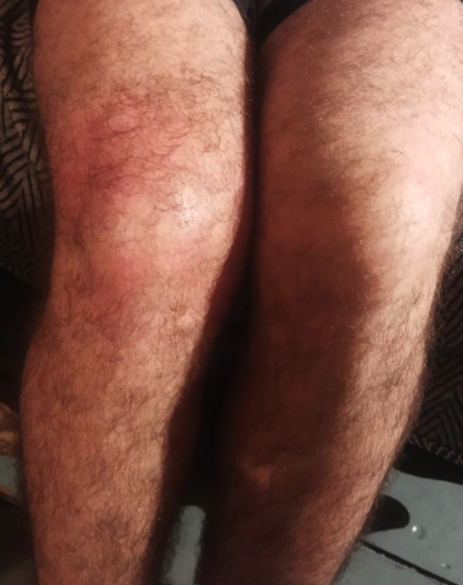 id_V_e2025.10.13.09.10.43_Mark_3.(better.pics.to.be.asked.to.doctor)_x
